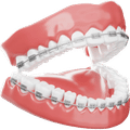 Braces Treatment