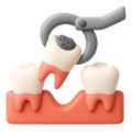 Tooth Extraction